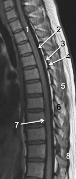 脊柱骨折的分型、诊断与治疗