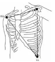 心电监护仪怎么看图解心电监护的观察及使用方法_https://www.jmylbn.com_新闻资讯_第20张