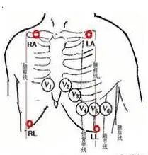 心电监护仪怎么看图解心电监护的观察及使用方法_https://www.jmylbn.com_新闻资讯_第18张