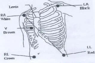 心电监护仪怎么看图解心电监护的观察及使用方法_https://www.jmylbn.com_新闻资讯_第21张