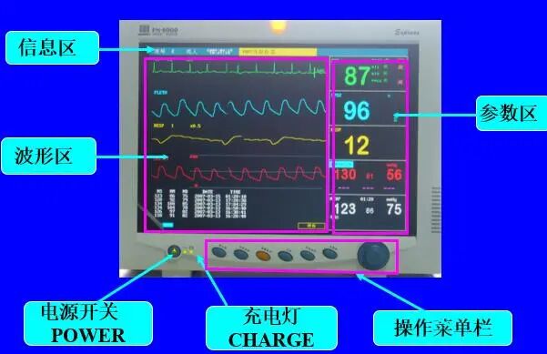 心电监护仪怎么看图解心电监护的观察及使用方法_https://www.jmylbn.com_新闻资讯_第8张