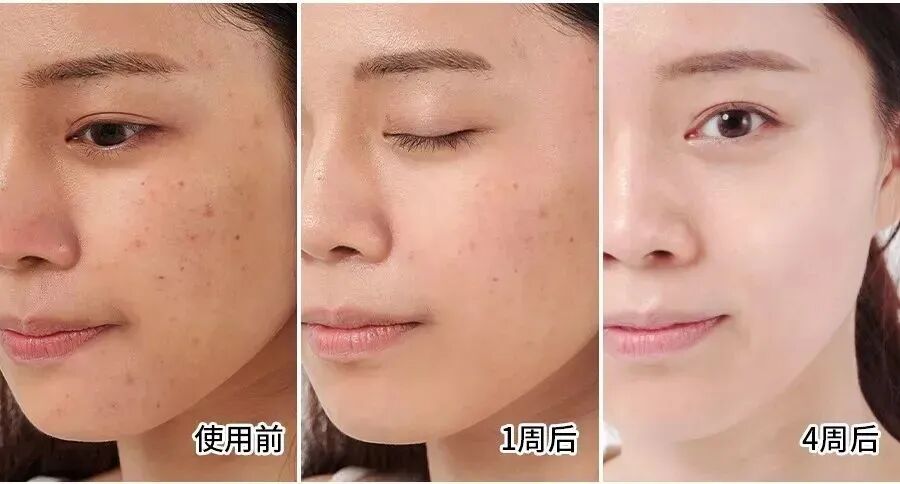 坚持使用Somaderm HGH凝胶，色斑，暗沉通通消失，皮