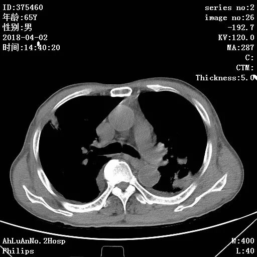 葡萄蜜虫钓黄辣丁_金黄葡萄球菌_伤口黄金色葡萄菌感染