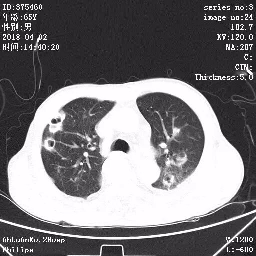 伤口黄金色葡萄菌感染_葡萄蜜虫钓黄辣丁_金黄葡萄球菌