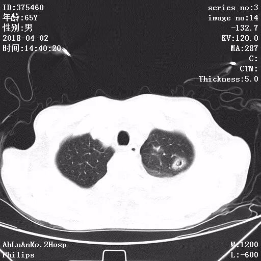 葡萄蜜虫钓黄辣丁_金黄葡萄球菌_伤口黄金色葡萄菌感染