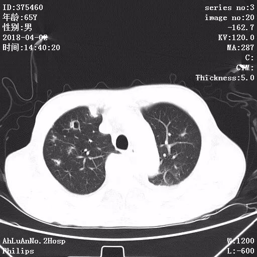 金黄葡萄球菌_葡萄蜜虫钓黄辣丁_伤口黄金色葡萄菌感染