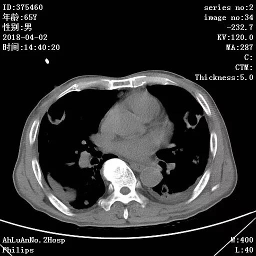 金黄葡萄球菌_伤口黄金色葡萄菌感染_葡萄蜜虫钓黄辣丁
