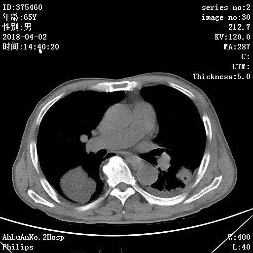 伤口黄金色葡萄菌感染_葡萄蜜虫钓黄辣丁_金黄葡萄球菌