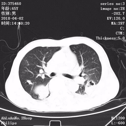 金黄葡萄球菌_葡萄蜜虫钓黄辣丁_伤口黄金色葡萄菌感染