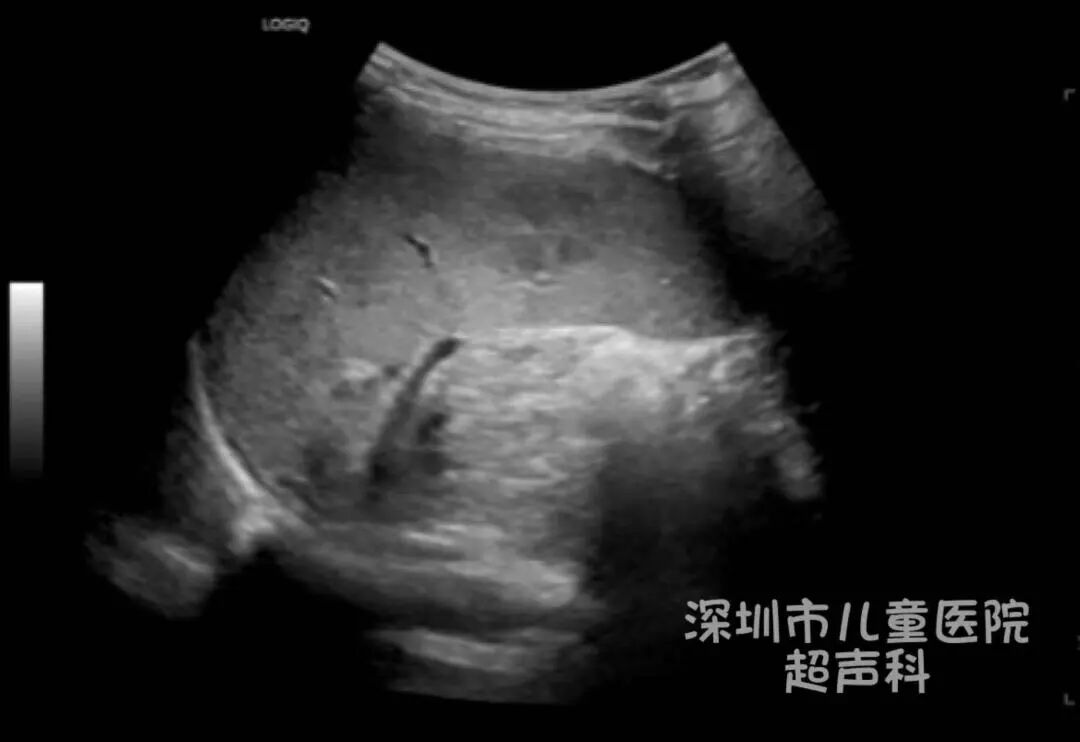 儿科微波是什么超声科普—超声引导下微波消融术-上海聚慕医疗器械有限公司