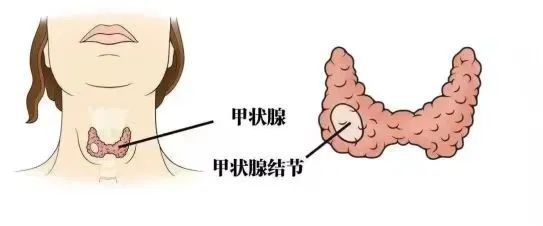 甲状腺疾病科普知识