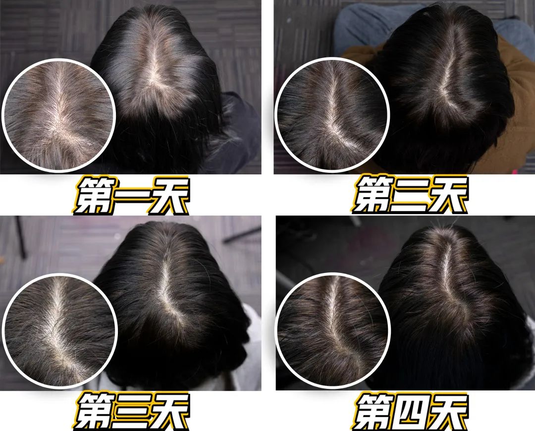 韩国之光、全球专业头皮护理专家Dr.FORHAIR发笙泡泡慕斯洗发水,进口精纯氨基酸+4种黑科技专利成分,强悍控油、洗1次管3天 韩国之光、全球专业头皮护理专家Dr.FORHAIR发笙泡泡慕斯洗发水,进口精纯氨基酸+4种黑科技专利成分,强悍控油、洗1次管3天