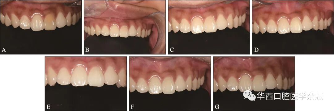牙胶尖什么颜色无髓变色牙内漂白术后1年临床效果观察_https://www.jmylbn.com_新闻资讯_第5张