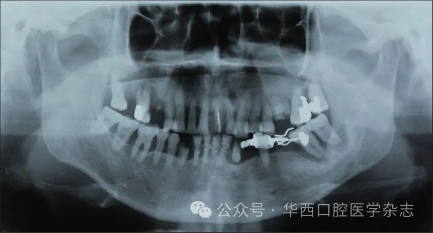 牙周炎一次拔14颗牙,【特约述评】重度牙周炎患牙拔除或挽救之思考