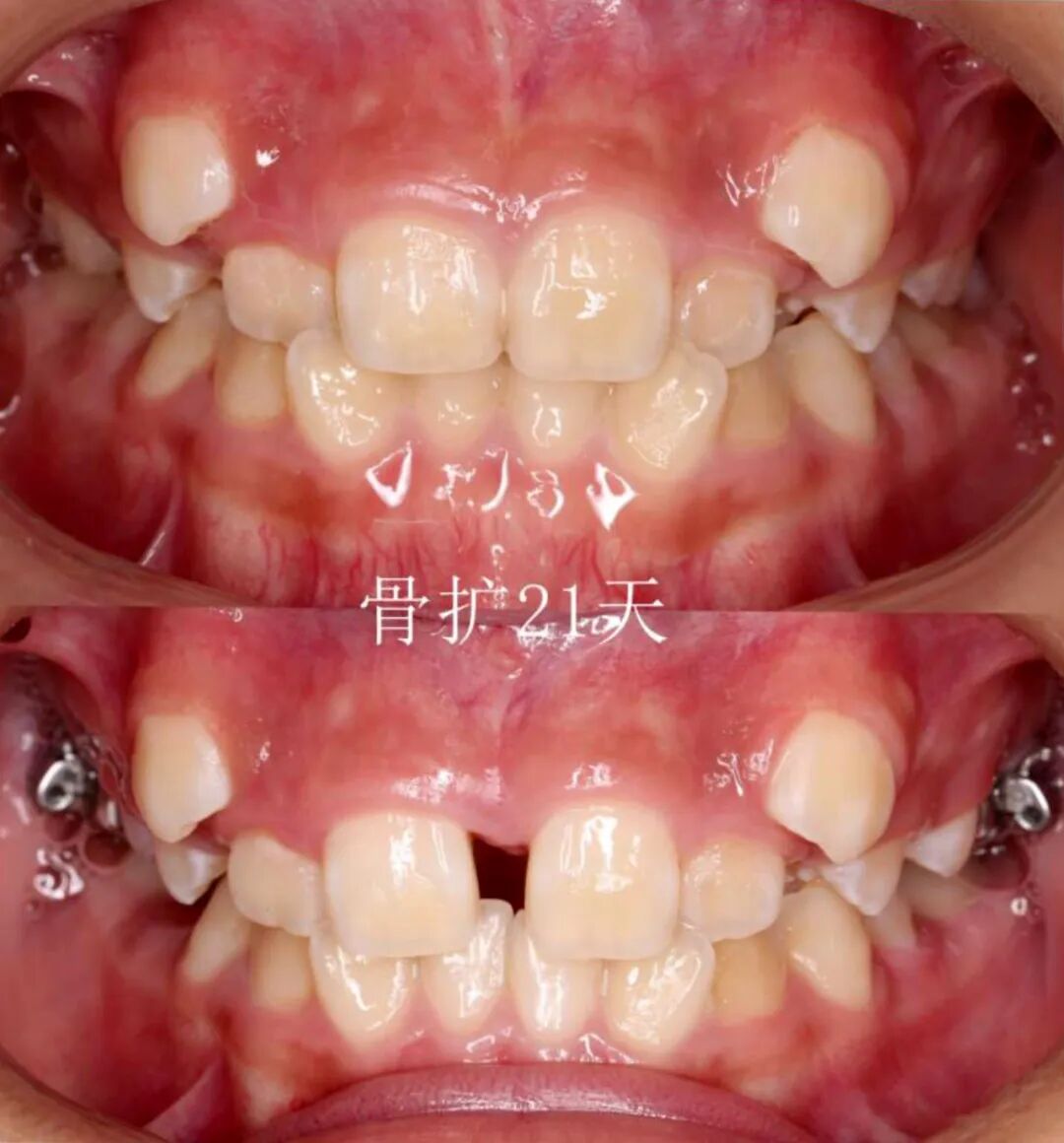 正畸临床病例——“横向先行”扩弓的方法与技巧