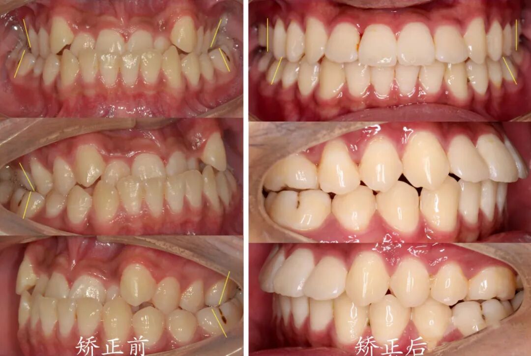 正畸临床病例——“横向先行”扩弓的方法与技巧