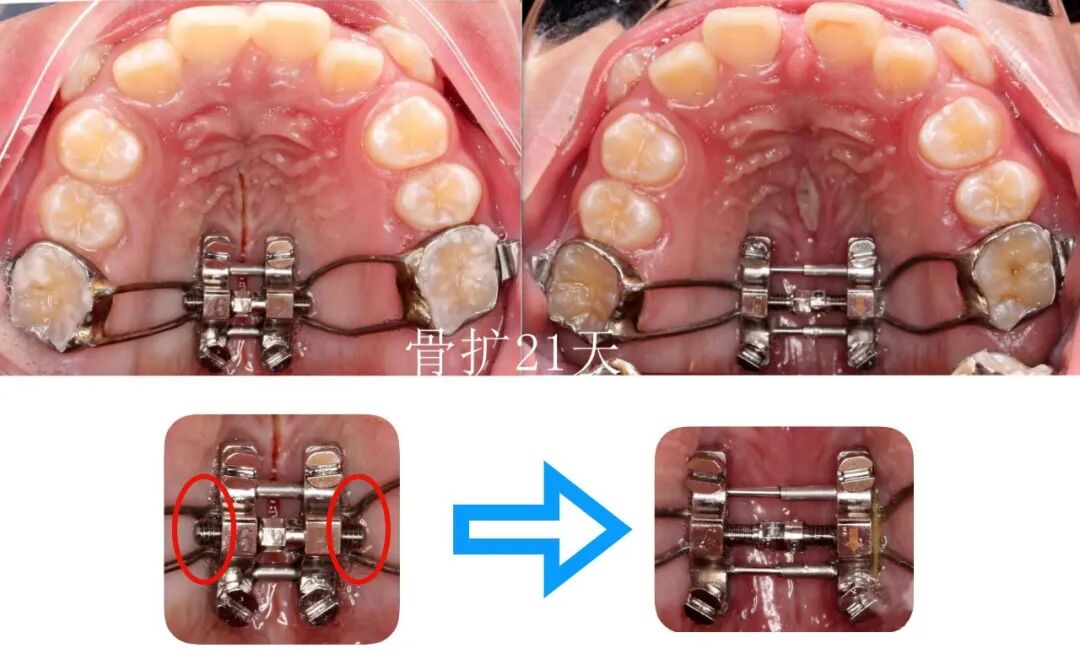 正畸临床病例——“横向先行”扩弓的方法与技巧