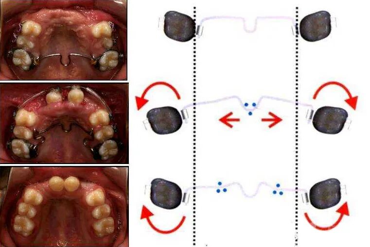 正畸临床病例——“横向先行”扩弓的方法与技巧