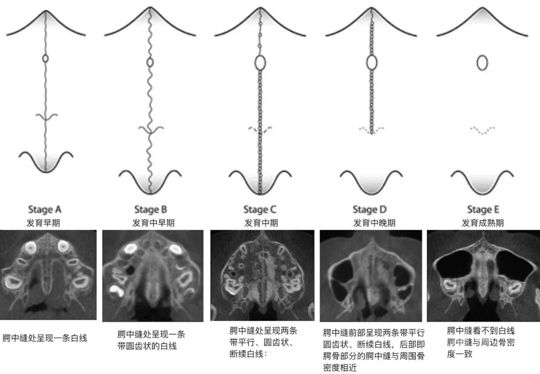 正畸临床病例——“横向先行”扩弓的方法与技巧