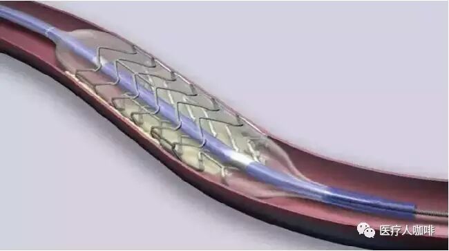 【血管支架】进口来自爱尔兰,出口则靠上海微创