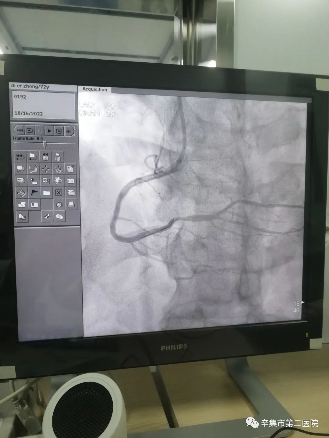 介入怎么进导管带您了解介入导管室的一天！_https://www.jmylbn.com_新闻资讯_第6张