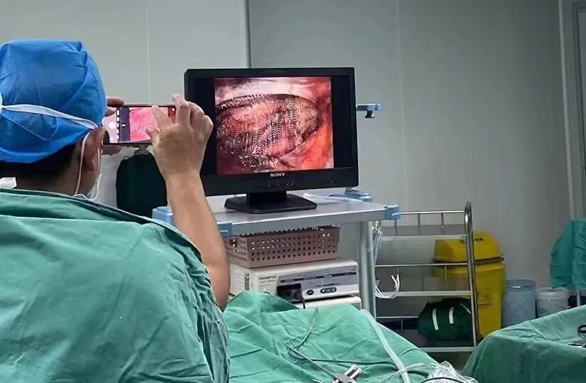 疝气补片怎么用疝外科小科普 ｜ 了解一下腹腔镜疝修补术用的“补片”吧！_https://www.jmylbn.com_新闻资讯_第1张