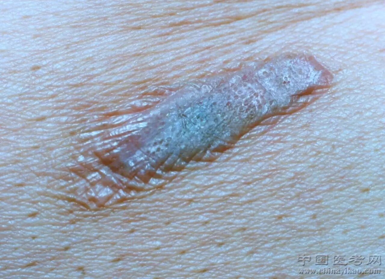 胸部月经疹294.腋下月经疹295.下肢和臀肢可变性红斑角化症296.