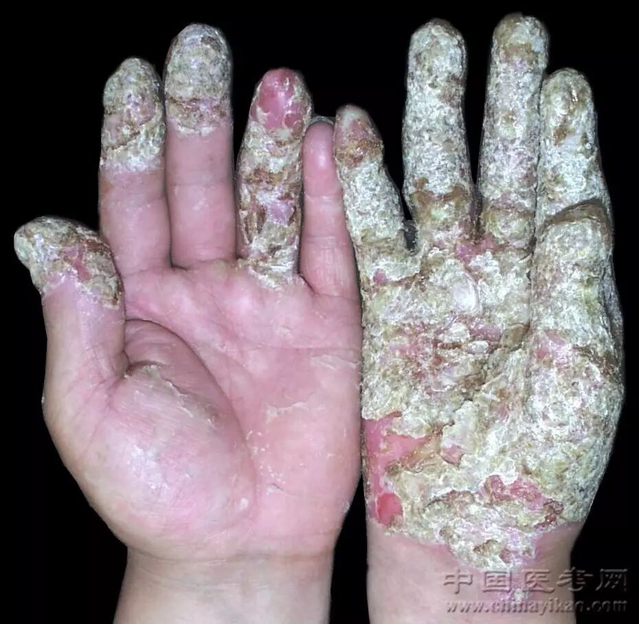 胸部月经疹294.腋下月经疹295.下肢和臀肢可变性红斑角化症296.