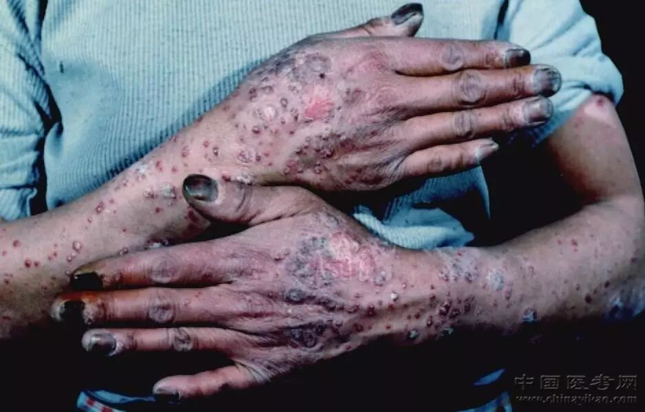 医学科普小编看完这个皮肤图谱整个人都不好了