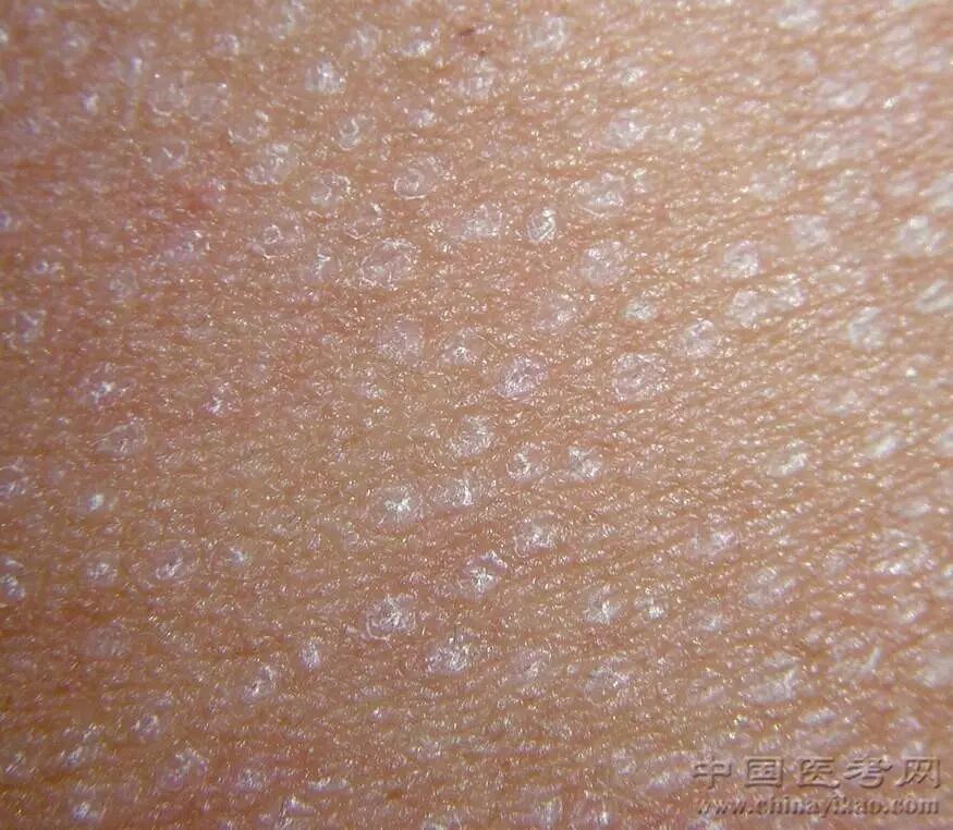 肩背部硬化性萎缩性苔癣283.肩背部硬化性萎缩性苔癣(放大图片)284.