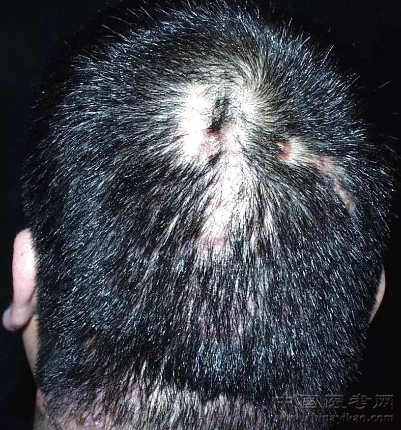 下肢蜂窝织炎48.颌面部须疮47.口周须疮46.颈部毛囊炎45.