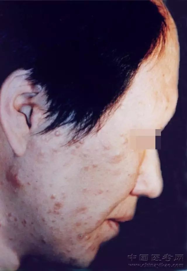 史上最全的皮膚病圖譜來了 修訂版 醫學生 微文庫