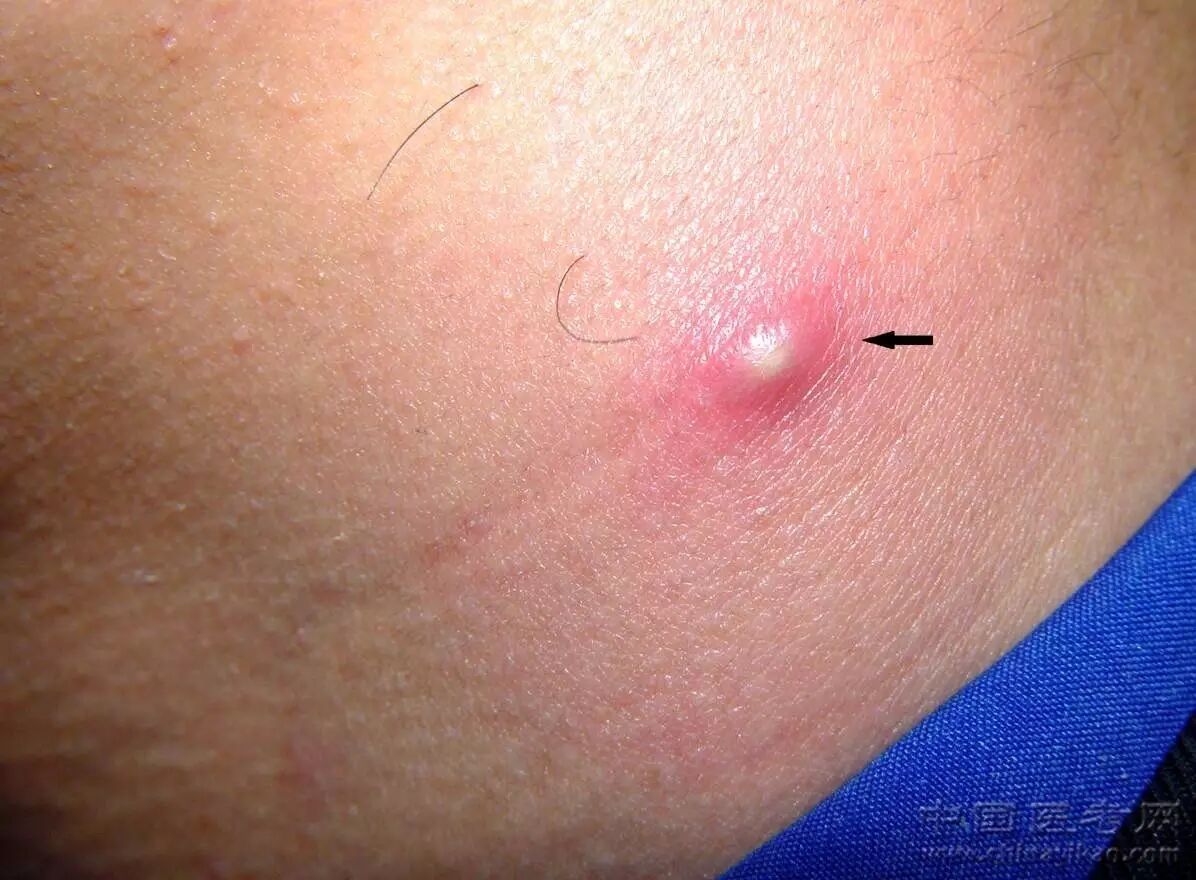 颈部毛囊炎45.面部毛囊炎44.下肢疖43.小腿丹毒42.面,手部深脓疱疮41.