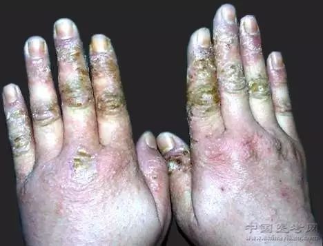 面部急性湿疹150.乳房放射性皮炎149.下肢火激性红斑(放大图像)148.