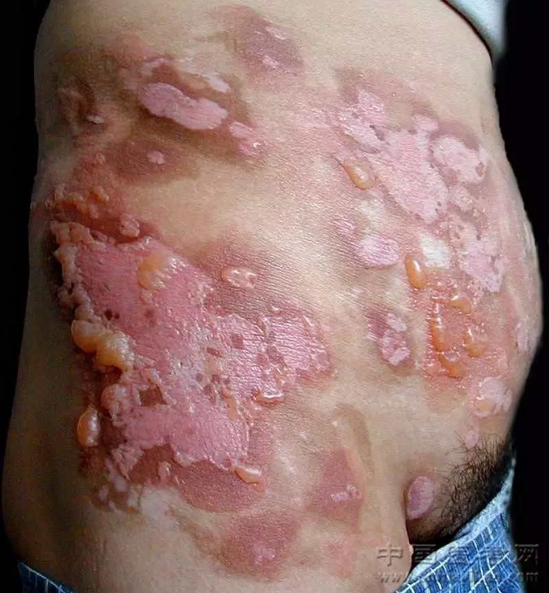 梅毒性白斑初期图片图片