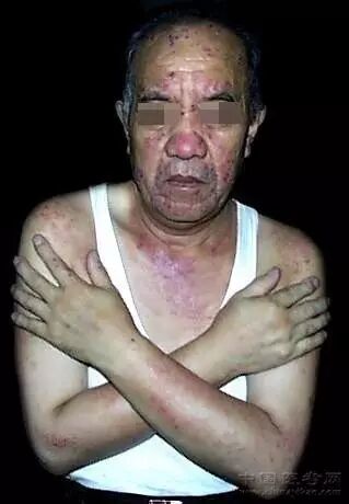 足心先天性梅毒疹(斑丘疹