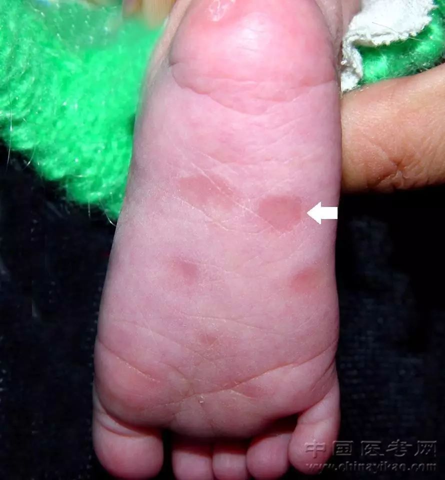 足心先天性梅毒疹(斑丘疹)127.手心先天性梅毒疹(斑丘疹)126.