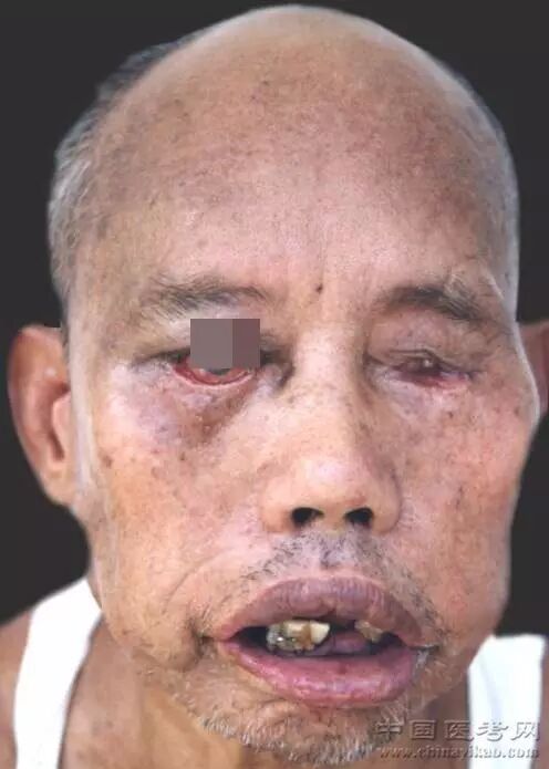 额头部疣状皮肤结核54.颈部寻常狼疮53.面部寻常狼疮52.