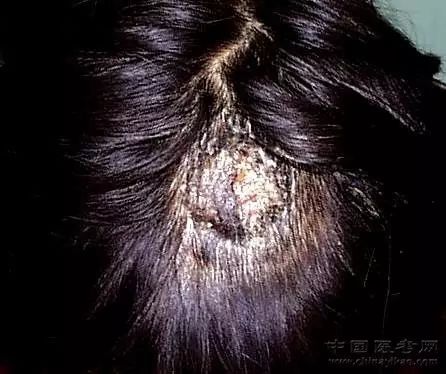 史上最全的皮膚病圖譜來了 修訂版 醫學之聲 微文庫