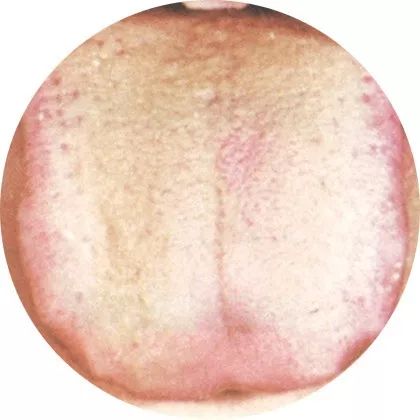 推动的功能受到影响,水液的输布功能减弱,于是出现舌体胖大且颜色淡白