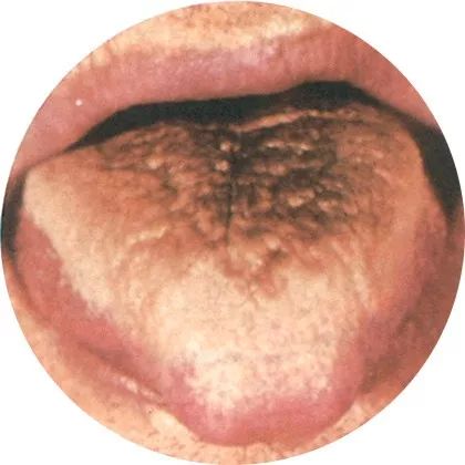 黑干苔表示受到慢性病,发炎的影响;黑腻苔表示体内长期积累过多的热邪