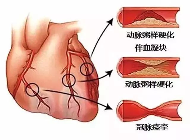 突發急性胸痛怎麼辦？這可能是你見到的最全的急救手冊！ 健康 第16張