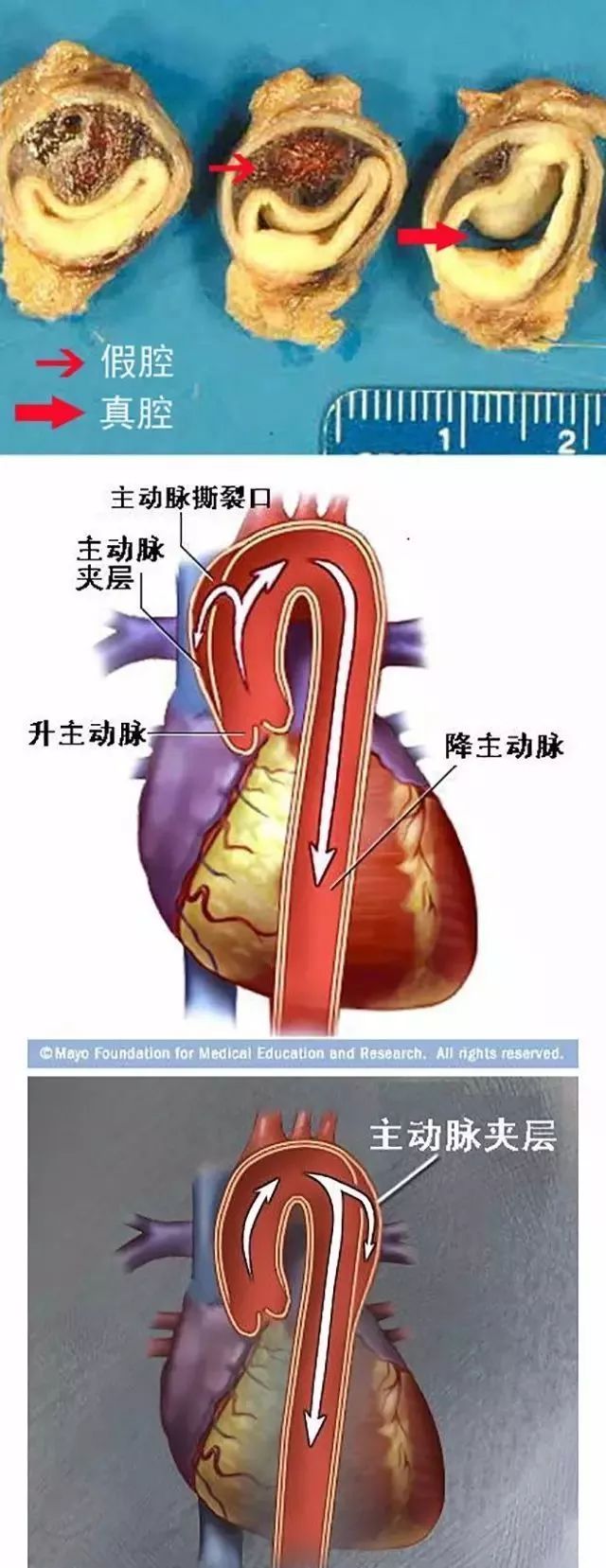 突發急性胸痛怎麼辦？這可能是你見到的最全的急救手冊！ 健康 第19張