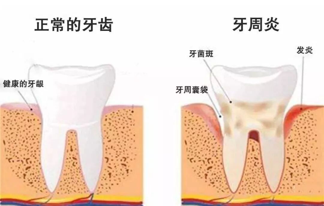 牙周病，健康牙齿的慢性杀手！