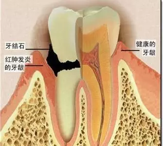 牙龈出血，得了牙龈炎该怎么办？