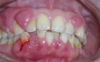 牙龈出血，得了牙龈炎该怎么办？