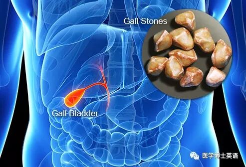 临床带教与英文查房 胆石症 二 自由微信 Freewechat