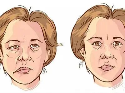 古法经络|你知道面瘫是什么原因引起的吗？