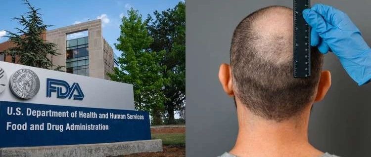 美国FDA刚刚批准：首个治疗斑秃脱发口服药，可恢复80%头发生长！