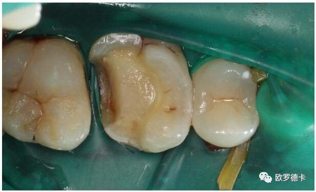 因为是急性牙髓炎,相对而言感染还局限在根管内,直接试尖,充填,一次性